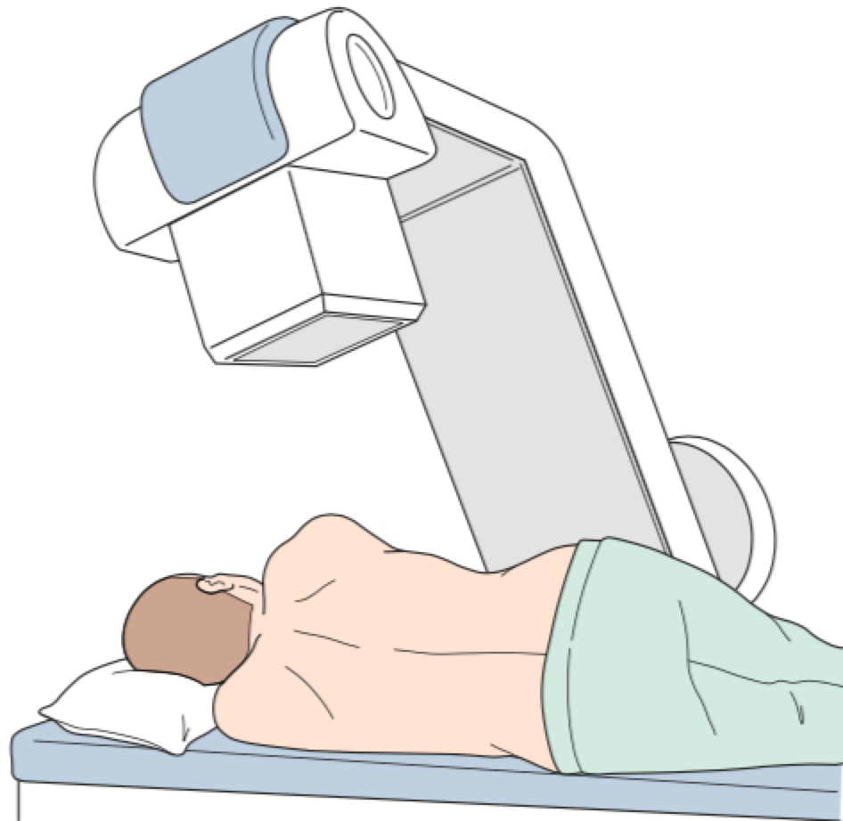 穿刺針を刺入する側（患側もしくは非患側）を決定し、穿刺手段に応じて患者を側臥位、もしくは斜位にする（X線管球を頭尾側に傾けることのできるX線透視装置が望ましい）。